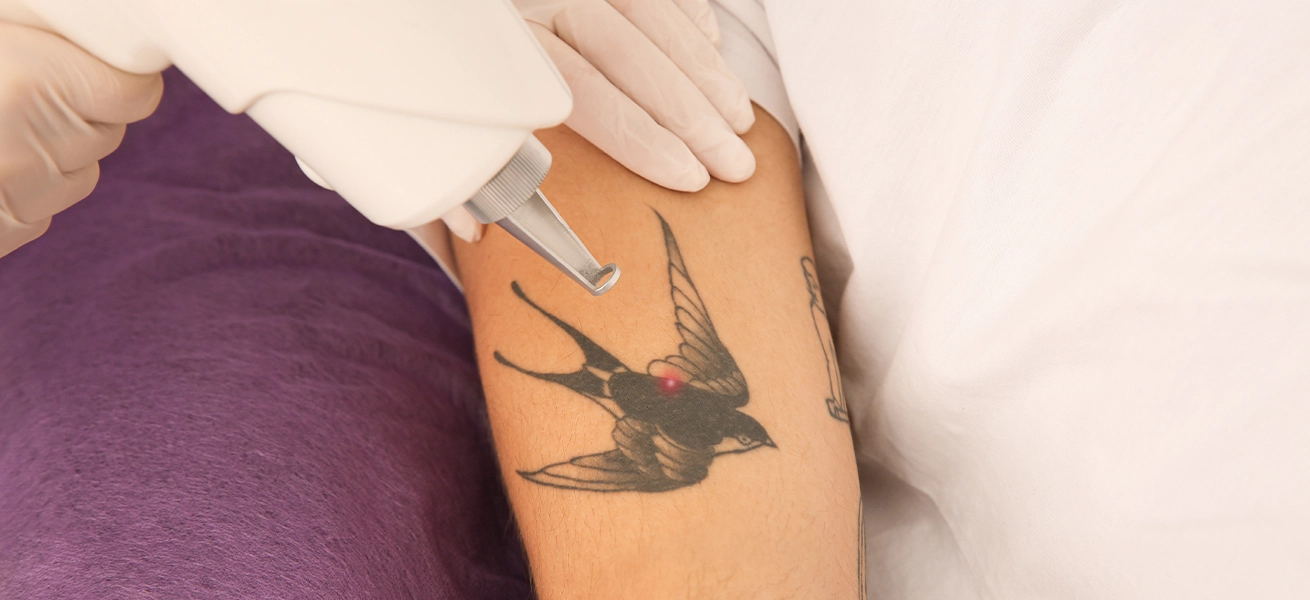 Safe and Effective Tattoo Removal Using Advanced Laser Technology2